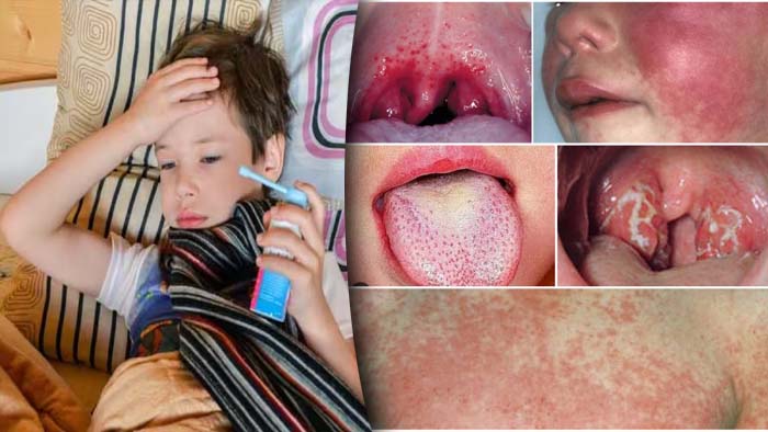 Strep A Scarlet Fever