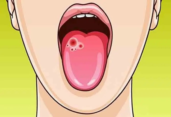 Oral Cancer : ఓరల్ క్యాన్సర్ అంటే ఏమిటి? లక్షణాలు ఏంటంటే?