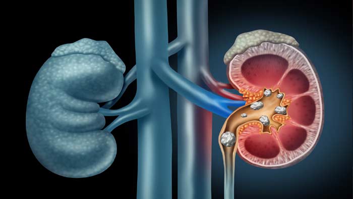 Kidney Stones: ఈ చిట్కాలు పాటించండి.. కిడ్నీలో రాళ్లు సులభంగా తొలగిపోతాయి..!