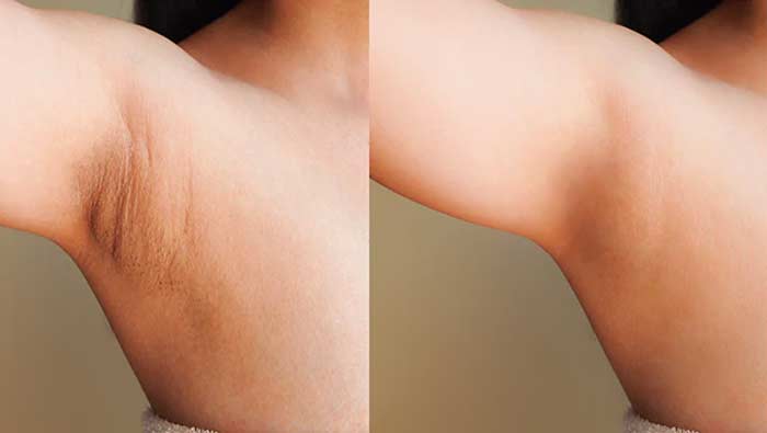 Dark Underarms : అండర్ ఆర్మ్ సమస్యకు సింపుల్ హోం రెమెడీస్