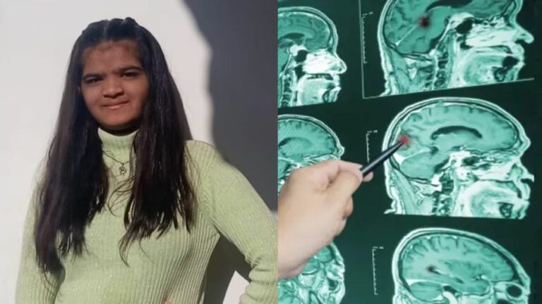 Brain Haemorrhage: 10వ తరగతిలో 99% మార్కులు సాధించిన అమ్మాయి.. బ్రెయిన్ హెమరేజ్ తో మృతి..