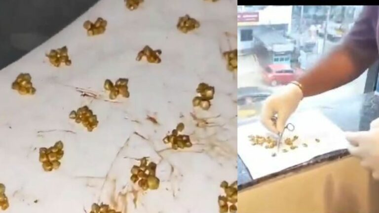 Gallbladder Stones: వామ్మో.. పిత్తాశయంలో 570 రాళ్లు.. చివరకు..