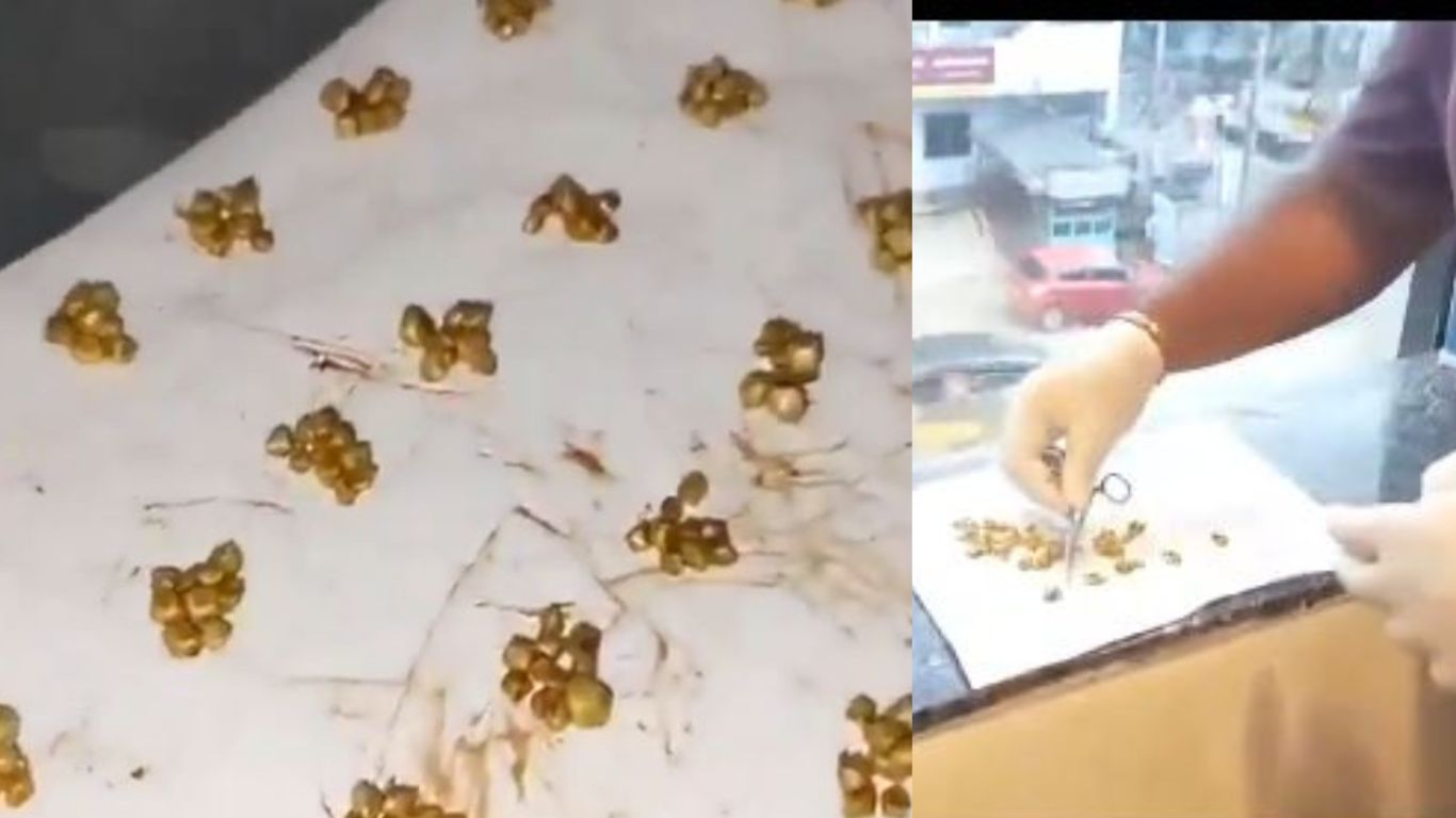 Gallbladder Stones: వామ్మో.. పిత్తాశయంలో 570 రాళ్లు.. చివరకు..