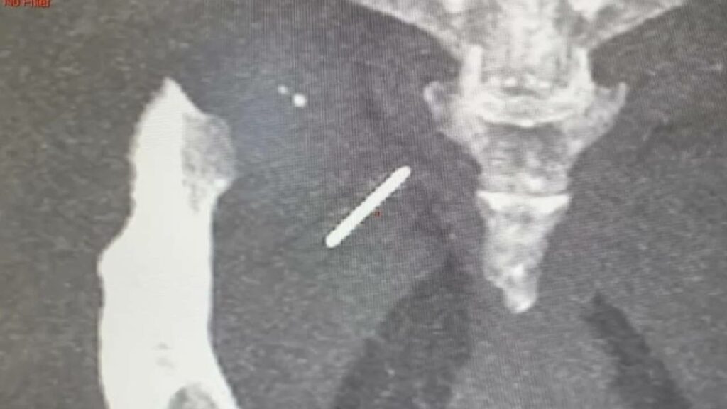 Needle Stuck In Woman's Hip