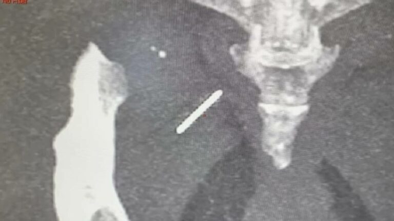 Needle Stuck In Hip: మహిళ తుంటిలో సూది.. 3 ఏళ్ల తర్వాత తొలగించిన డాక్టర్లు..