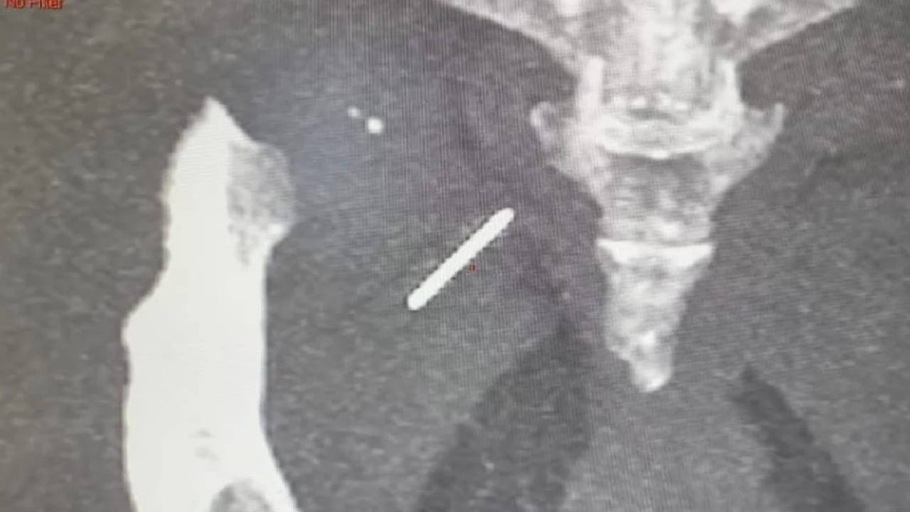 Needle Stuck In Hip: మహిళ తుంటిలో సూది.. 3 ఏళ్ల తర్వాత తొలగించిన డాక్టర్లు..