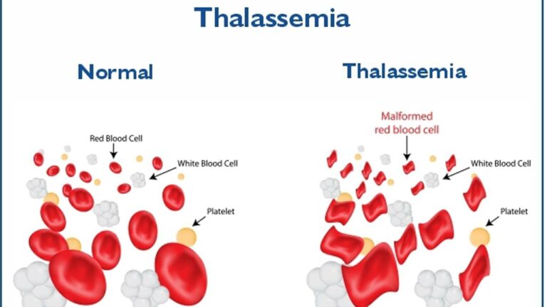 Thalassemia : భారతదేశంలో తలసేమియా కేసులు ఎక్కువ.. ఎందుకలా..?