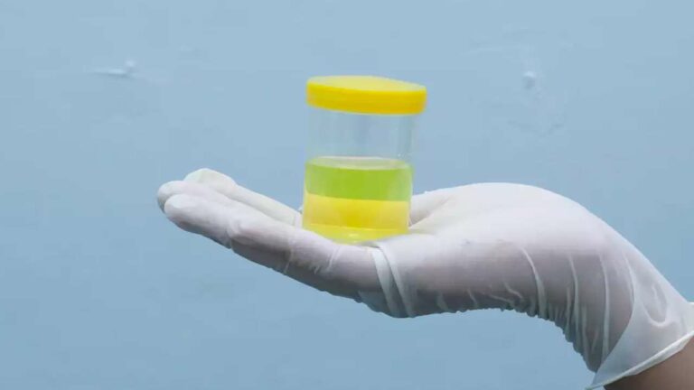 Yellow Urine Reasons: ఈ కారణాల వల్ల మూత్రం పసుపు రంగులోకి మారవచ్చు.. వెంటనే వైద్యుడిని సంప్రదించండి!