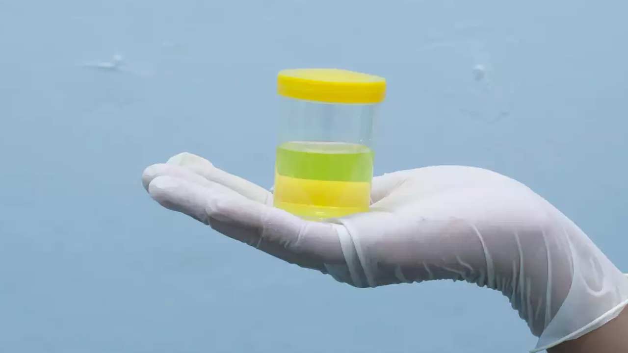 Yellow Urine Reasons: ఈ కారణాల వల్ల మూత్రం పసుపు రంగులోకి మారవచ్చు.. వెంటనే వైద్యుడిని సంప్రదించండి!