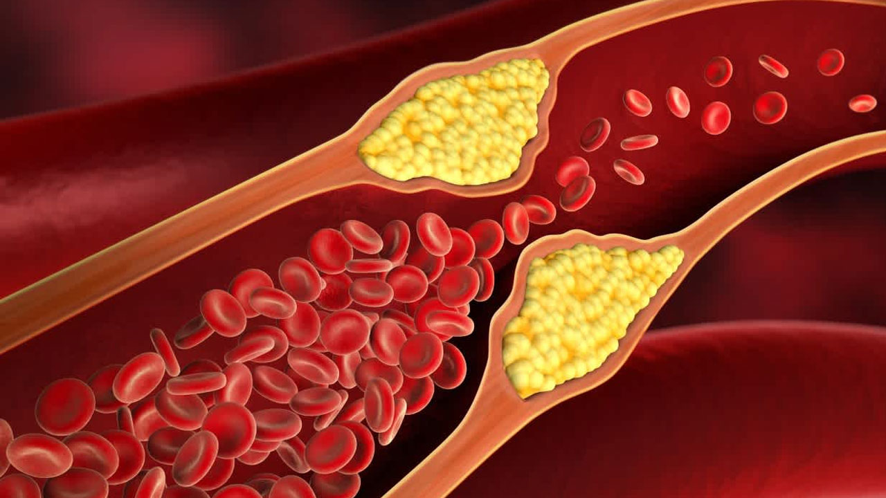 Cholesterol: ప్రతి ఏడాది కొలెస్ట్రాల్ వల్ల 44 లక్షల మంది మరణిస్తున్నారు.. తగ్గించే మార్గాలు ఇవే!