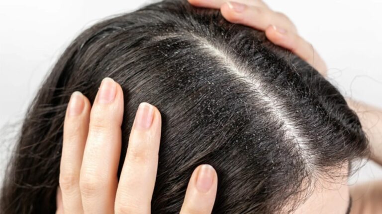 Dandruff And Hair Loss : చుండ్రు రావడానికి, జుట్టు రాలడానికి గల కారణాలు ఇవే.. జాగ్రత్త సుమా..