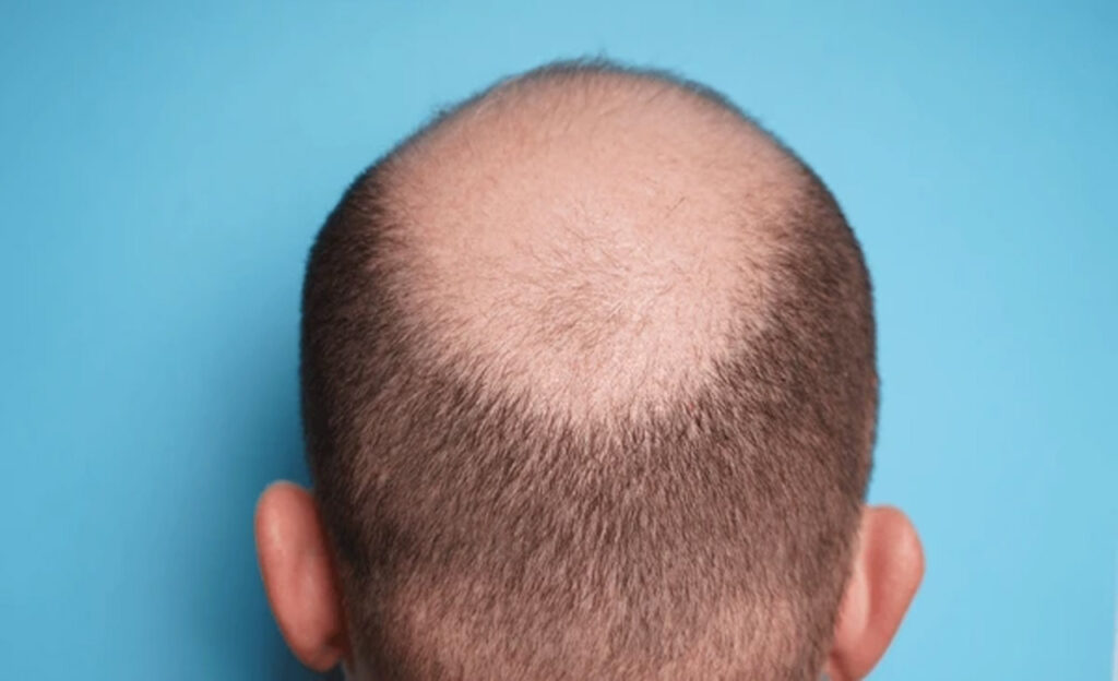 Men Bald Head
