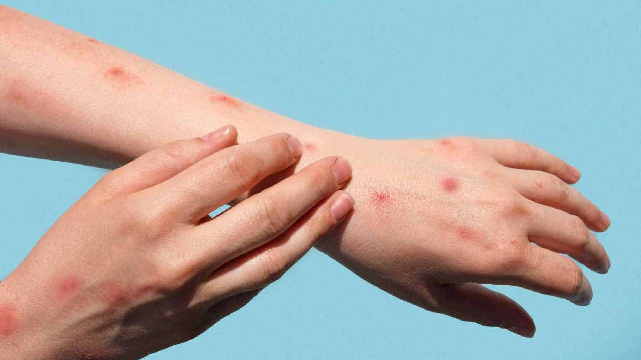 Mpox: “ఎంపాక్స్ వైరస్” ముంచుకొచ్చే ప్రమాదం.. శాస్త్రవేత్తల హెచ్చరిక..