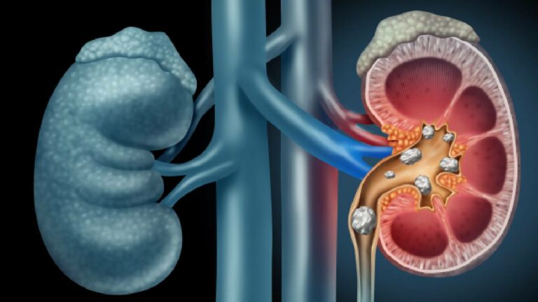 Kidney Stone: ఈ నియమాలు పాటించండి.. కిడ్నీలో రాళ్లు తొలగేలా చేయండి
