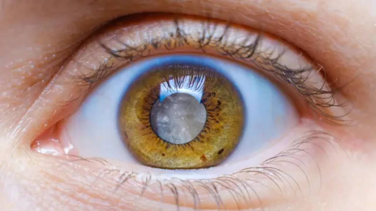 Eyes Care Tips: కంటి శుక్లం సమస్య దరిచేరకుండా ఉండాలంటే ఇలా చేయండి..