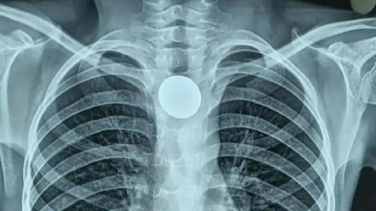 Coin Stuck In Throat: బాలుడి గొంతులో ఇరుక్కున్న నాణేం..7 ఏళ్ల తర్వాత తొలగింపు..