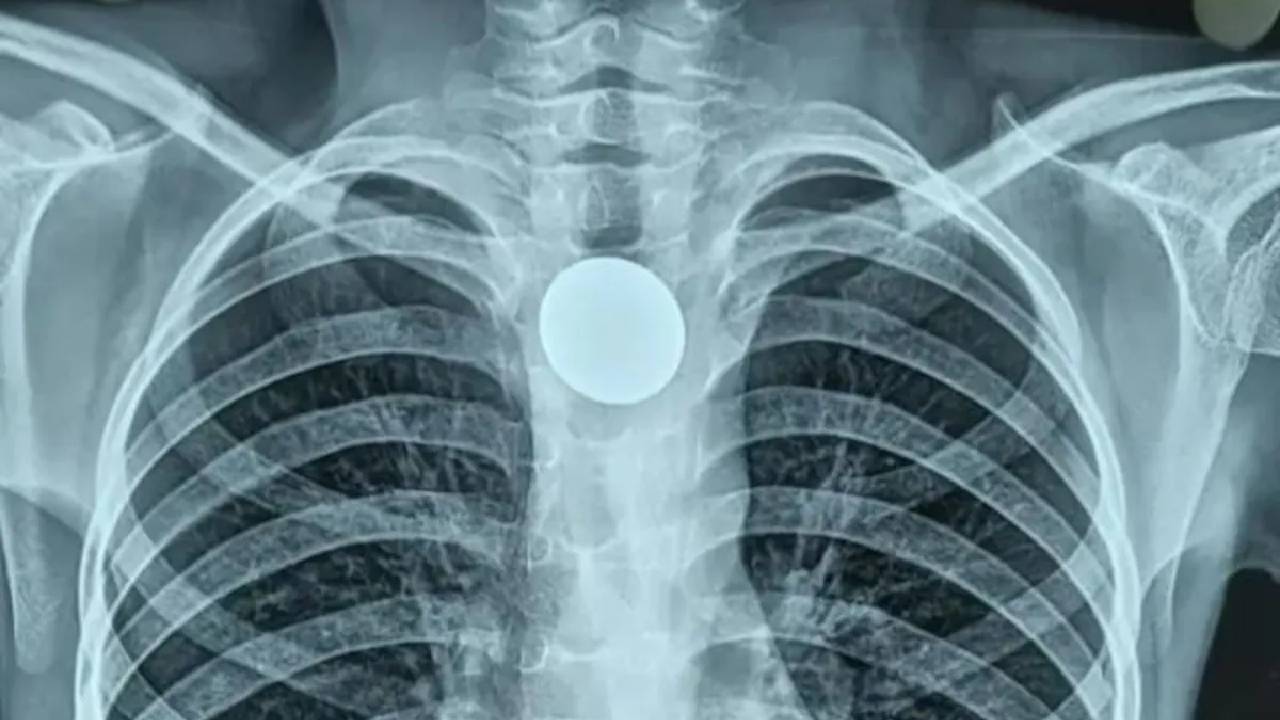 Coin Stuck In Throat: బాలుడి గొంతులో ఇరుక్కున్న నాణేం..7 ఏళ్ల తర్వాత తొలగింపు..