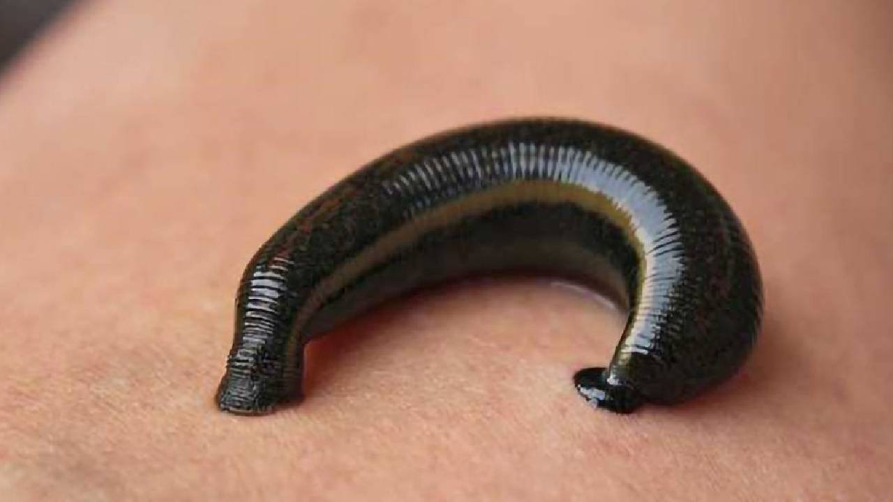 Leech Found In Nose: మనిషి ముక్కులో “జలగ”.. అరుదైన శస్త్రచికిత్స..