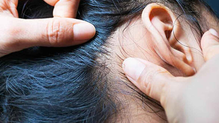 Removing Lice: తలలో పేనులు పోవాలంటే ఈ చిట్కాలు పాటించండి..!