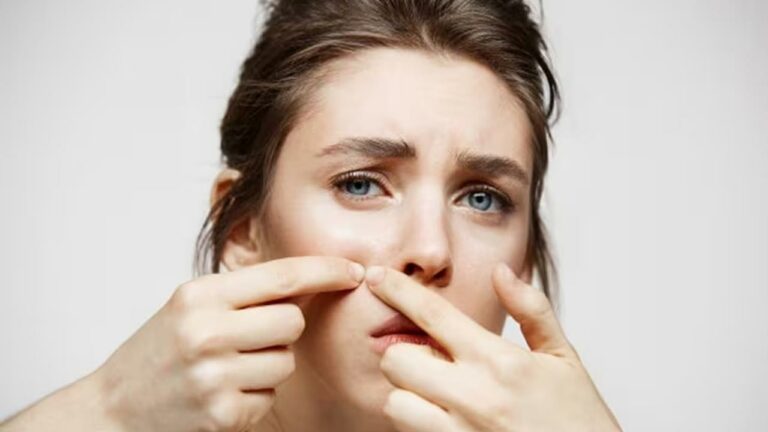 Acne Problem: ముఖంపై మొటిమలతో ఇబ్బంది పడుతున్నారా.. ఇలా చేయండి..