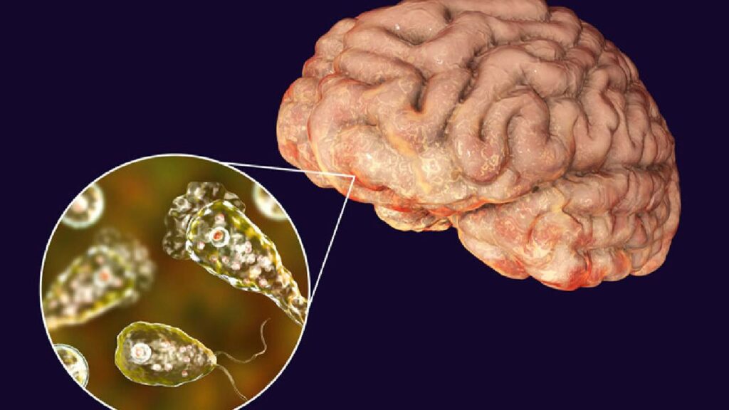 Brain Eating Amoeba