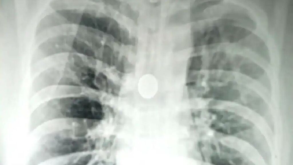 Coin Stuck In Man's Windpipe