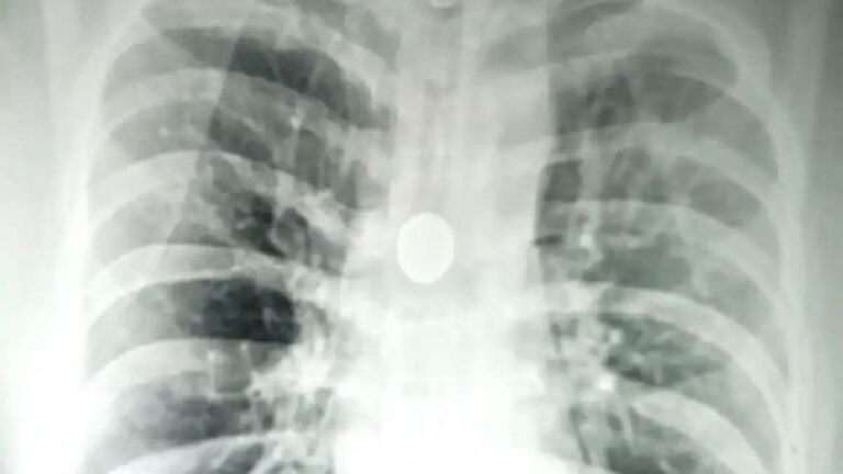 Coin Stuck In Man’s Windpipe: వ్యక్తి శ్వాసనాళంలో 8 ఏళ్లుగా 25 పైసల నాణేం.. అరుదైన శస్త్రచికిత్స..