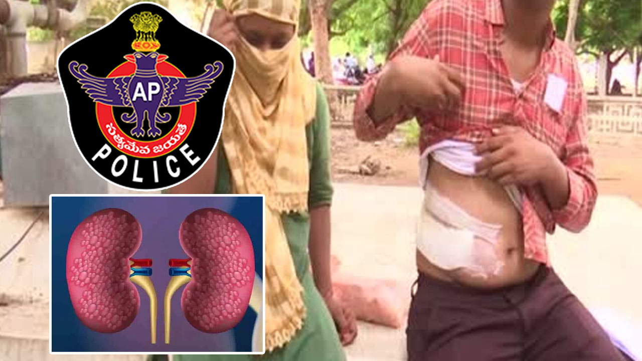 Kidney Racket Scam: కలకలం రేపుతోన్న కిడ్నీ మాఫియా.. మూలాలపై పోలీసుల ఫోకస్