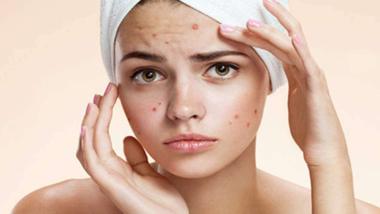 Pimples On Face : ముఖంపై పదే పదే మొటిమలు ఇబ్బంది పెడుతున్నాయా.. ఐతే ఇలా చేయాల్సిందే..