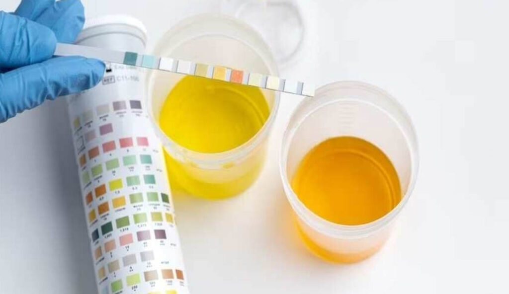 Urine Color