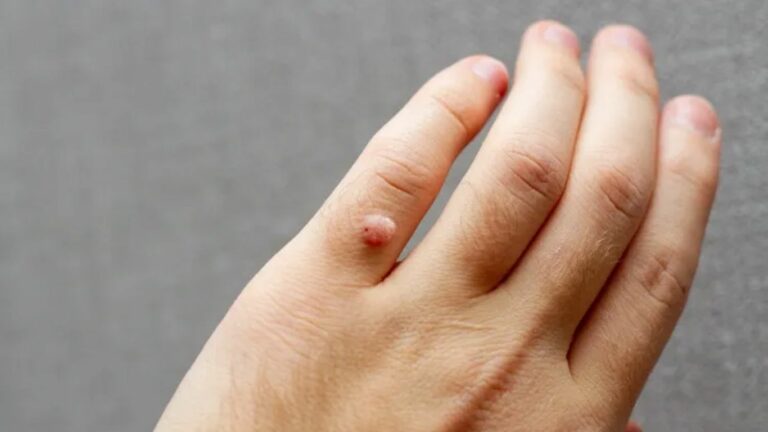 Warts Remove Naturally: ఎలాంటి నొప్పి లేకుండా పులిపిర్లను సహజంగా ఇలా తొలగించుకోండి!