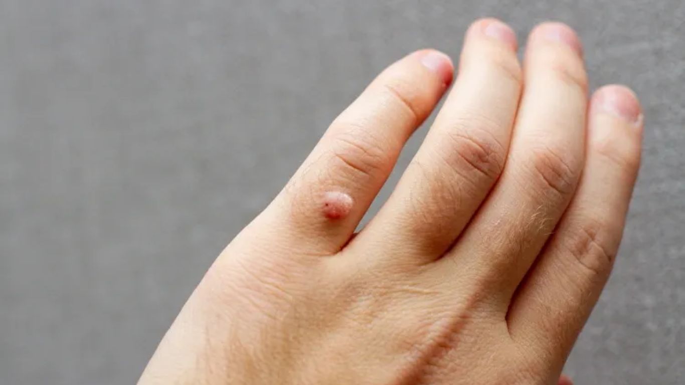 Warts Remove Naturally: ఎలాంటి నొప్పి లేకుండా పులిపిర్లను సహజంగా ఇలా తొలగించుకోండి!