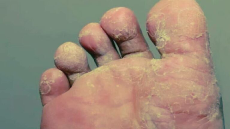 Rainy season Footcare: వర్షాకాలంలో పాదాల సంరక్షణ తప్పనిసరి..లేదంటే ఫంగల్‌ ఇన్‌ఫెక్షన్లు తప్పవు..