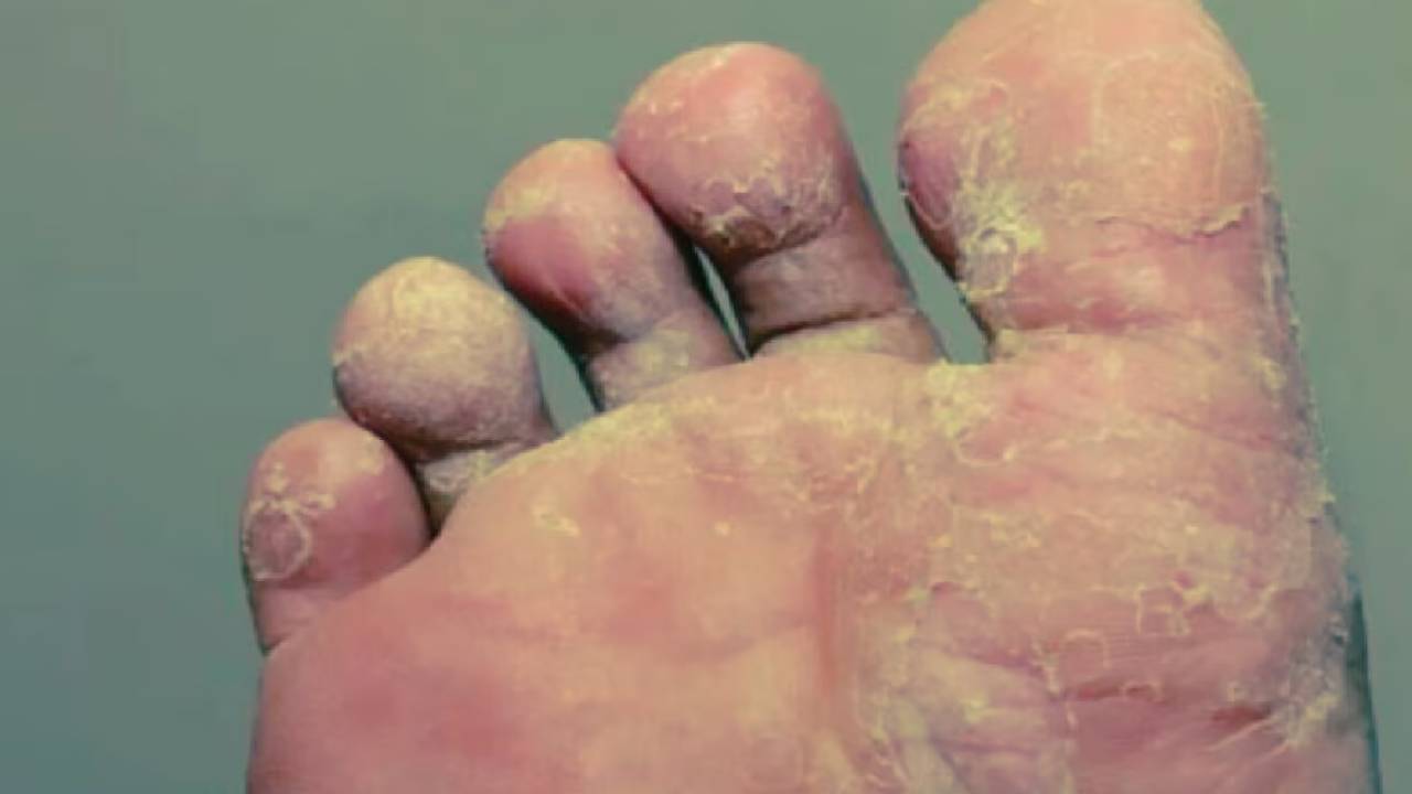 Rainy season Footcare: వర్షాకాలంలో పాదాల సంరక్షణ తప్పనిసరి..లేదంటే ఫంగల్‌ ఇన్‌ఫెక్షన్లు తప్పవు..