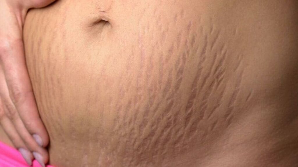 Stretch Marks