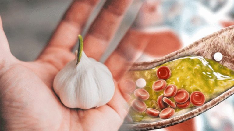 Cholesterol Reduce: వెల్లుల్లి కొలెస్ట్రాల్ తగ్గించడానికి ఎలా ఉపయోగపడుతుందంటే..?