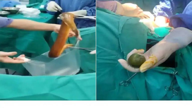 Vietnam: భారతీయ వ్యక్తి ప్రైవేట్ పార్ట్‌లోకి బతికి ఉన్న ఈల్.. కడుపులో పేగుల్ని తీనేసింది..