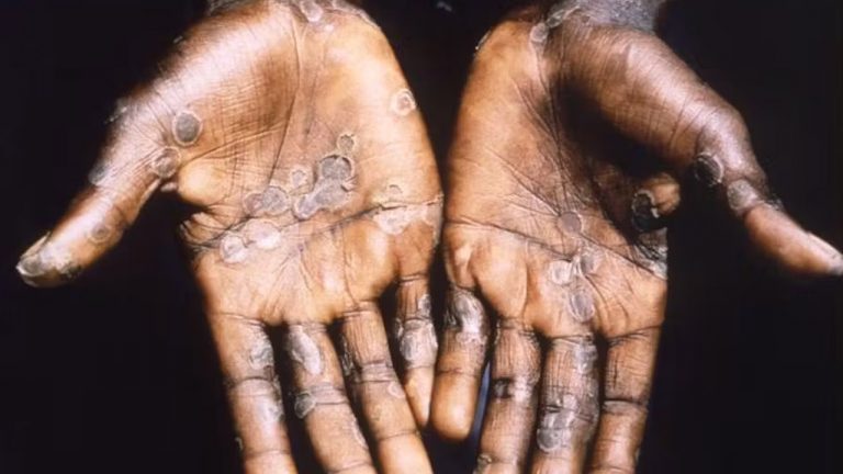 Monkeypox: భయపెడుతున్న మంకీపాక్స్.. ఎలా వ్యాపిస్తుంది.. లక్షణాలేంటి..?