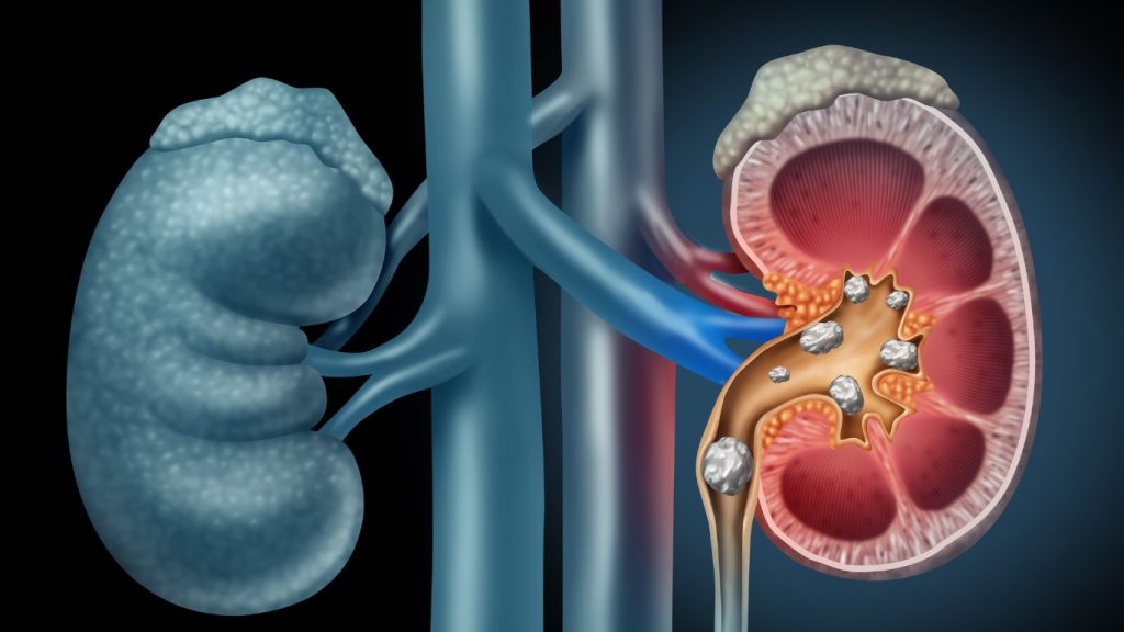 Stones In Kidney