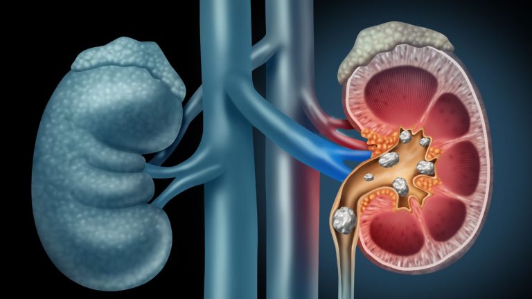 Stones In Kidney: కిడ్నీలో రాళ్లతో ఇబ్బందులా..? ఇలా చేయండి ఉపశమనం పొందండి..