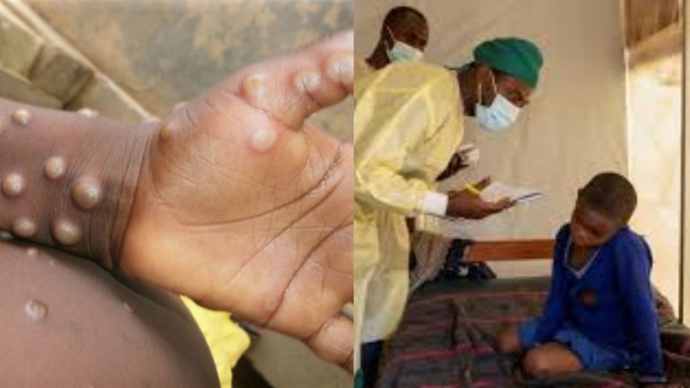 Mpox – WHO: హెల్త్‌ ఎమర్జెన్సీ ప్రకటించిన WHO.. ఎంపాక్స్ విజృంభణ‌..