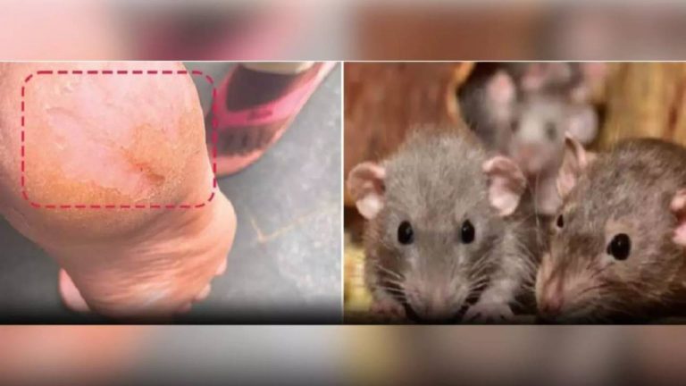 Nalgonda : ఎలుకలు కరిచి 14 మంది విద్యార్థులకు గాయాలు