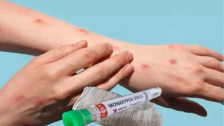 Mpox Vaccine: మంకీపాక్స్ వ్యాక్సిన్ కు ఆమోదం తెలిపిన డబ్ల్యూ హెచ్ వో
