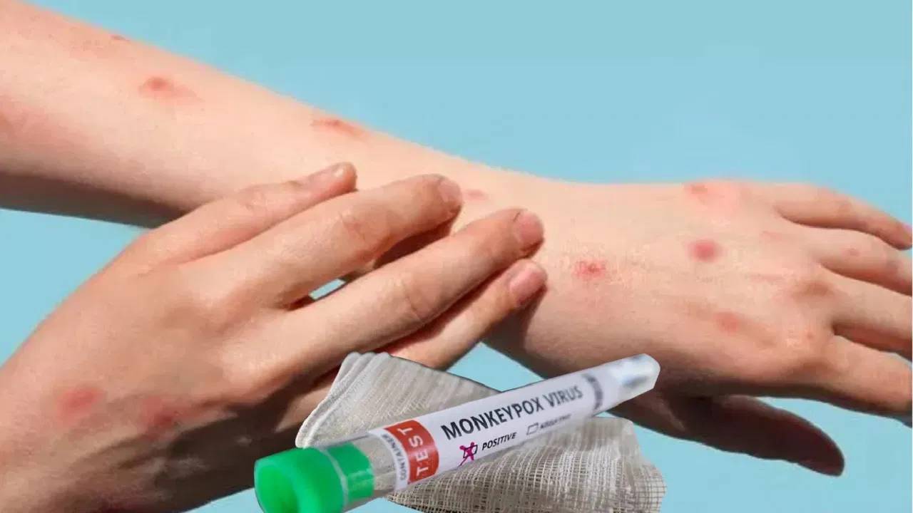Mpox Vaccine: మంకీపాక్స్ వ్యాక్సిన్ కు ఆమోదం తెలిపిన డబ్ల్యూ హెచ్ వో
