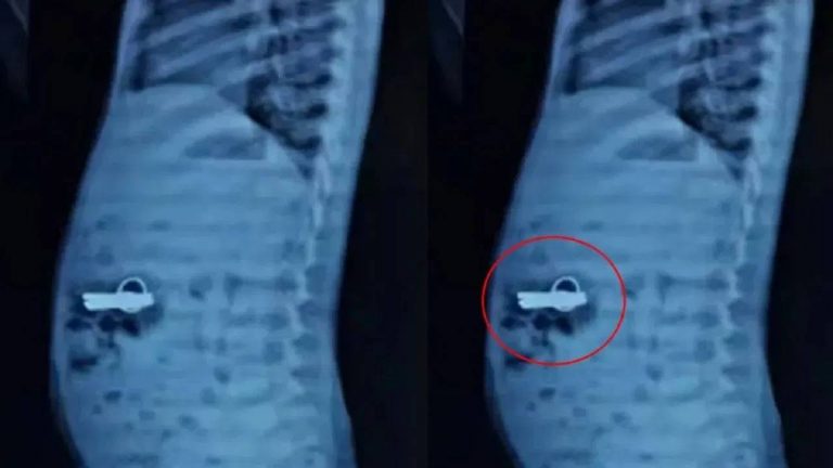 Gujarat : కీ చైన్ మింగిన మూడేళ్ల బాలుడు.. ఈ టెక్నిక్ తో తీసిన వైద్యులు