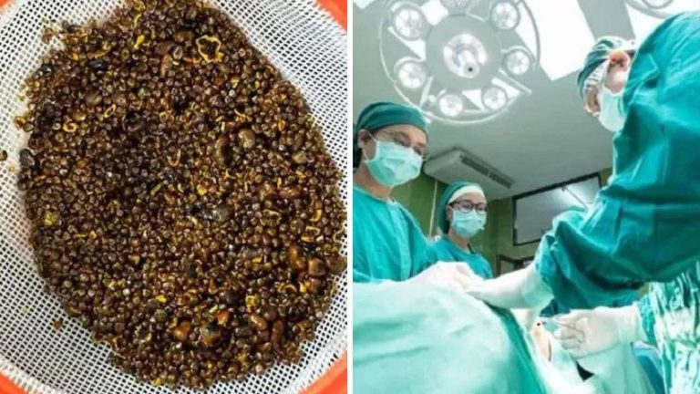 6110 Stones in Stomach : డాక్టర్లకే చెమటలు పట్టించిన ఆపరేషన్.. కడుపులో ఏకంగా 6110 రాళ్లు