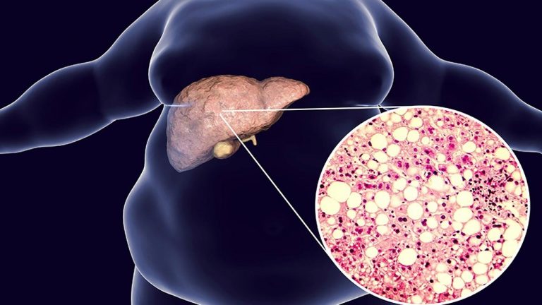 Fatty Liver: డాకర్ట్ చెప్పిన రహస్యం..! ఫ్యాటీ లివర్ నయం కావాలంటే ఈ చిట్కాలు పాటించండి..