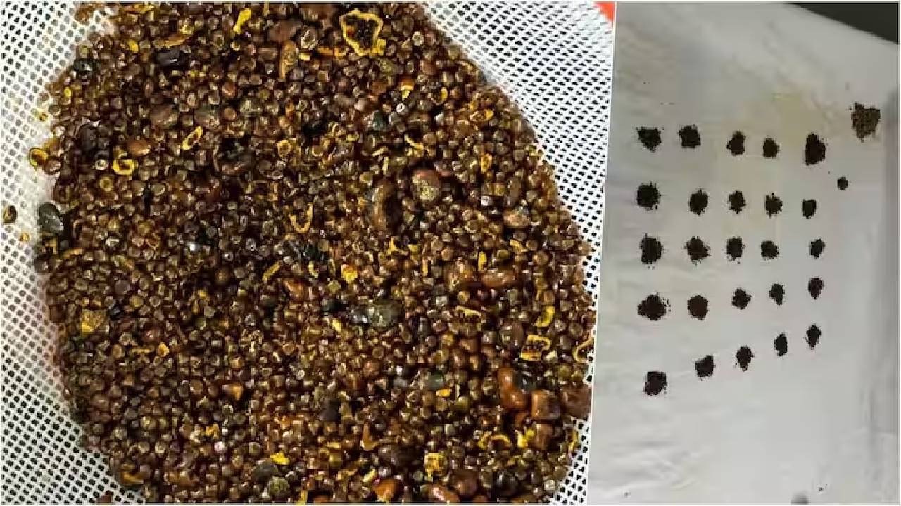 Rajasthan: రాళ్లు వెనకేసుకోవడం అంటే ఇదేనేమో.. వ్యక్తి గాల్‌బ్లాడర్ నుంచి 6000 రాళ్లు తొలగింపు..