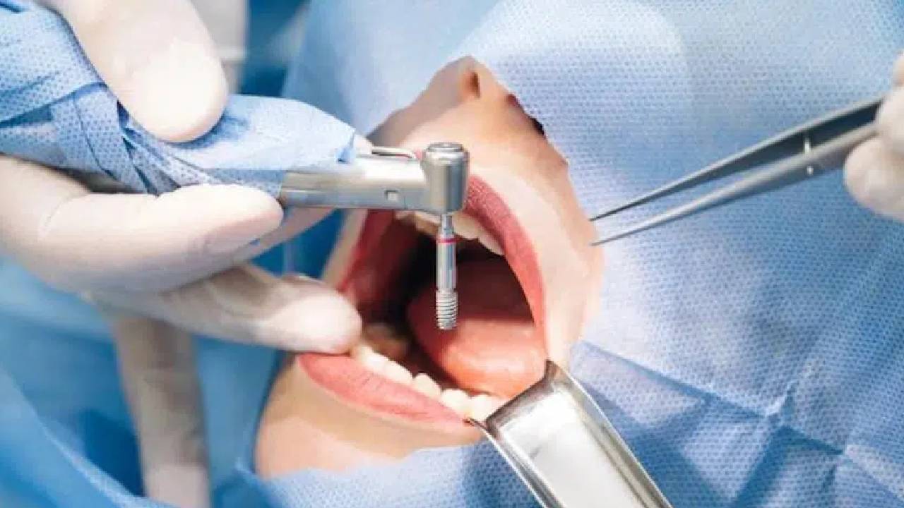 Teeth Implants: ఒకే రోజు 23 దంతాలు.. గుండెపోటుతో పేషెంట్ మృతి..