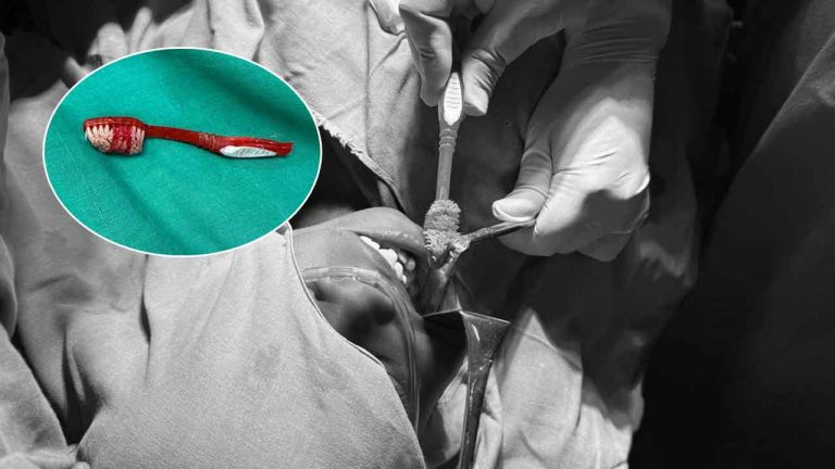 Toothbrush: పళ్లు తోముతుండగా ఊహించని ఘటన.. బాలుడు దవడలోకి చొచ్చుకుపోయిన టూత్ బ్రష్..